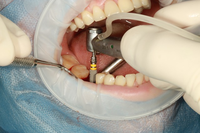 Dental implant in lees summit