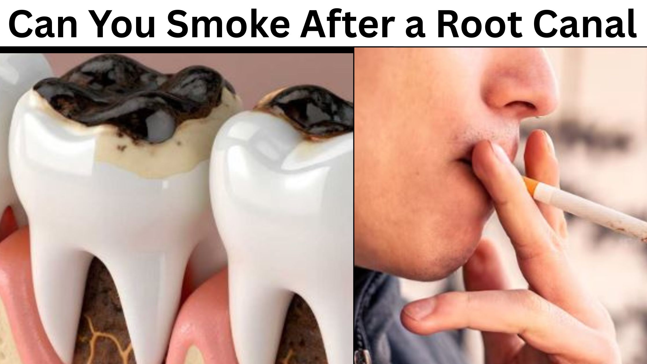 Can You Smoke After a Root Canal